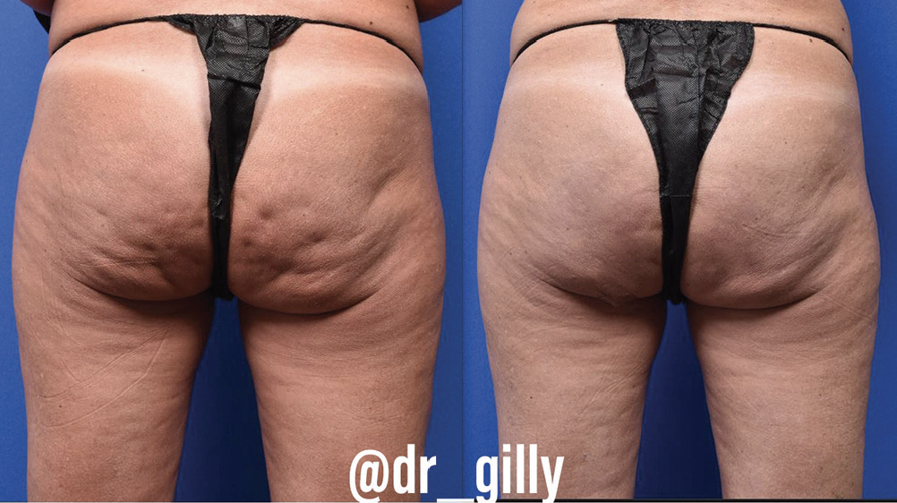 Subcision for Cellulite Treatment