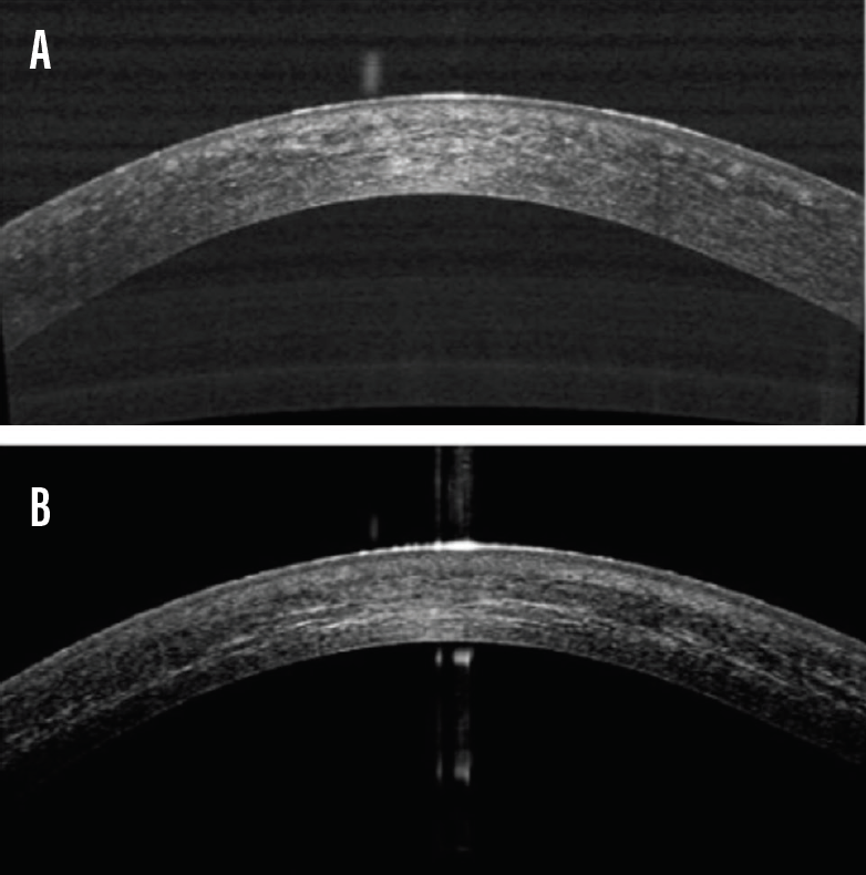 Updates in Keratoconus Management and the FDAApproved iLink Cross