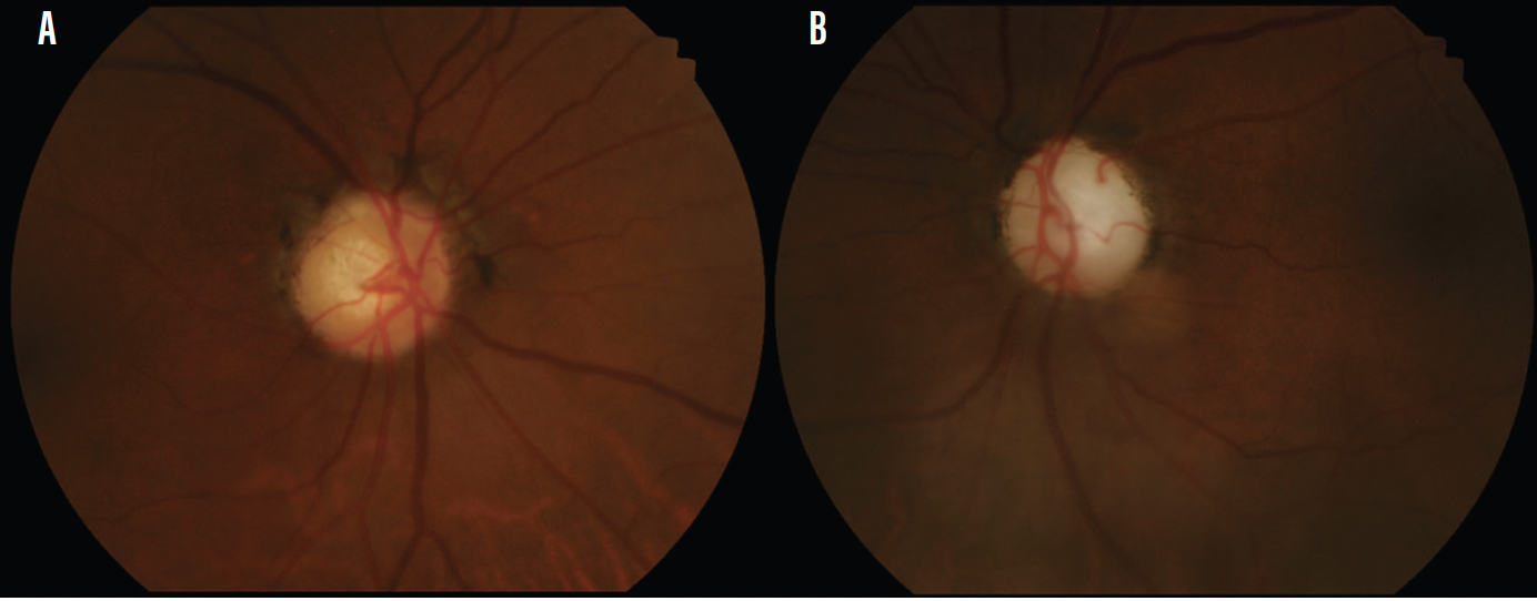 A Case Of Multiple Visual Field Defects Secondary To Glaucoma Modern Optometry