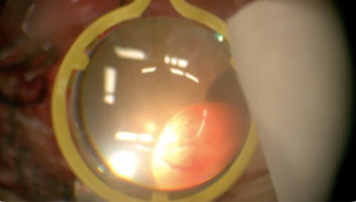 Vasoproliferative Tumor