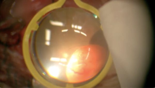 Vasoproliferative Tumor thumbnail