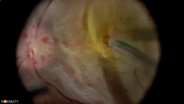 Diabetic Tractional Retinal Detachment thumbnail