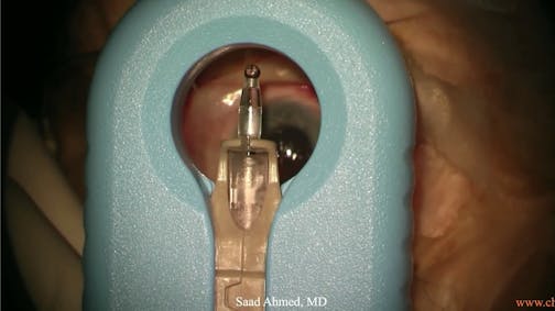 Susivimo: The Port Delivery System & Preparing the Implant