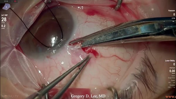 Susvimo: Surgical Pearls & Tricks #1 (Peritomy) thumbnail