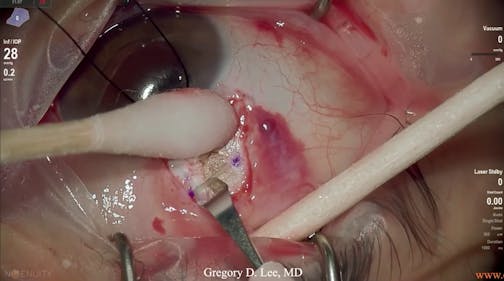 Susvimo: Surgical Pearls & Tricks #2 (Scleral incision and laser)