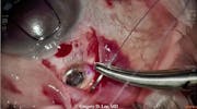Susvimo: Surgical Pearls & Tricks #4 (Conjunctival closure)