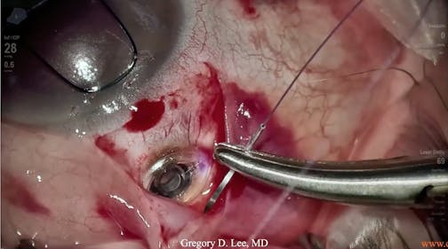 Susvimo: Surgical Pearls & Tricks #4 (Conjunctival closure)