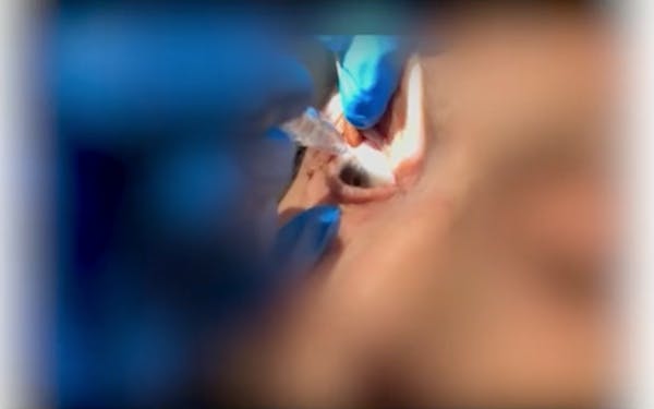 Susvimo: Implant Refill & Final Thoughts thumbnail