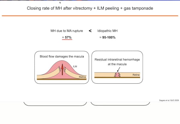 Submacular Hemorrhage thumbnail
