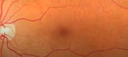 Iridex EpM Endpoint Management™ Sub-threshold Treatment for Retinal Disorders
