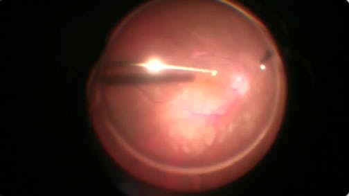 Intraocular Injection