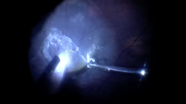 Persistent Fetal Vasculature thumbnail