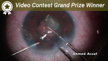 Managing a Routine White Intumescent Cataract thumbnail