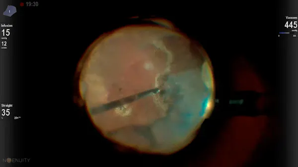 Ganciclovir Implant thumbnail