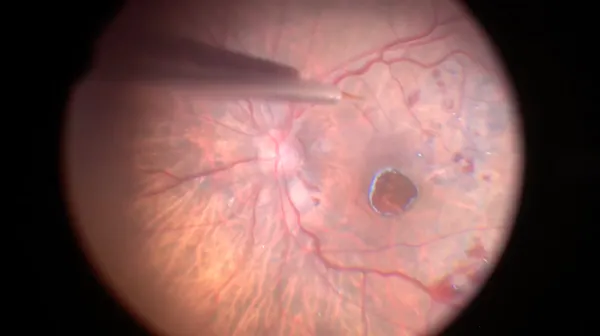 Large Macular Hole & Subretinal Air thumbnail