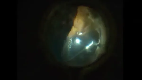 Hemorhagic Retinal Detachment thumbnail