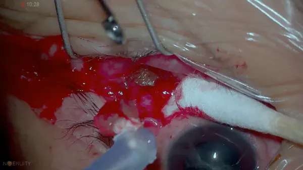 Miragel Scleral Buckle thumbnail