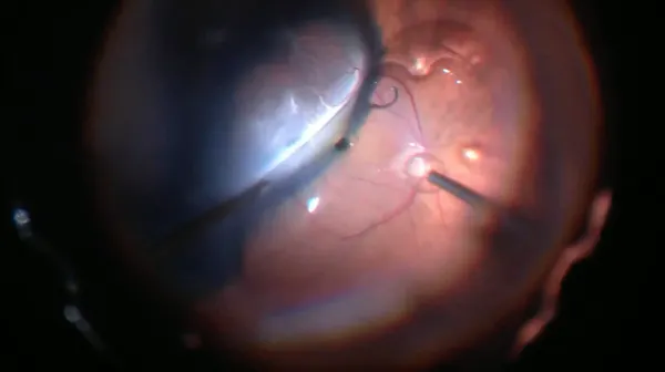 Iatrogenic Macular Hole thumbnail
