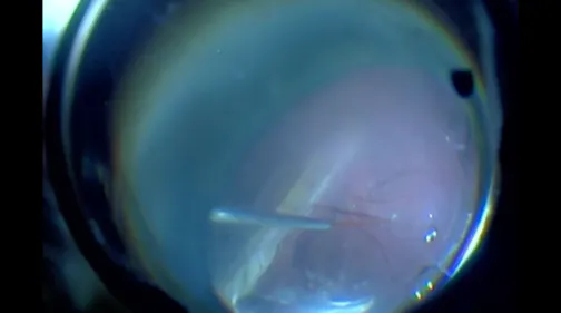Macular Fold