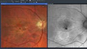 Fluid on Focus: Neovascular AMD Management Redefined by ZEISS Retina Workflow