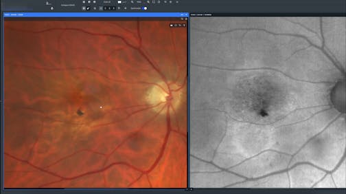 Fluid on Focus: Neovascular AMD Management Redefined by ZEISS Retina Workflow