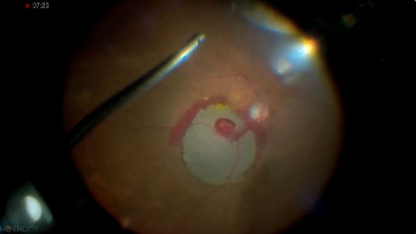 Submacular Surgery thumbnail