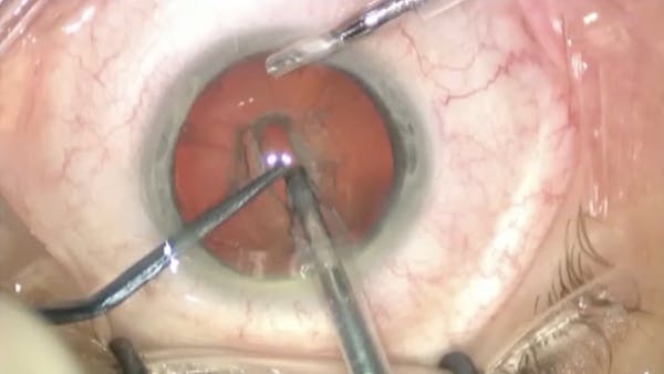 ESCRS Binkhorst Lecture thumbnail