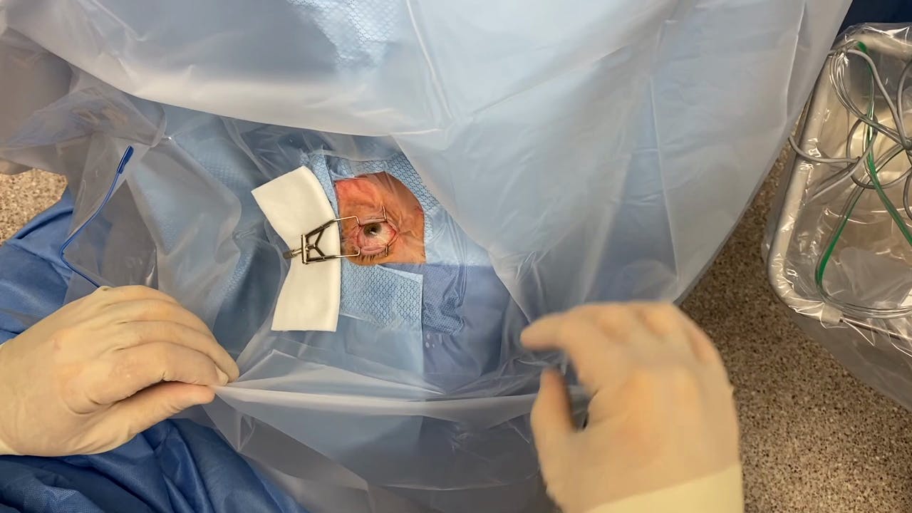 Cataract Surgery Draping Technique Eyetube