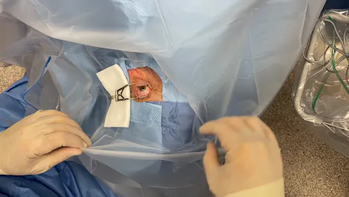 Cataract Surgery Draping Technique