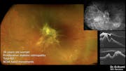 Proliferative Diabetic Retinopathy