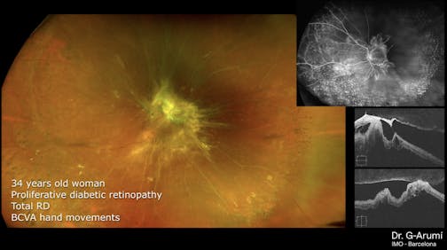 Proliferative Diabetic Retinopathy