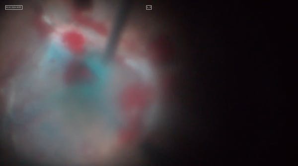 Subretinal Dye thumbnail