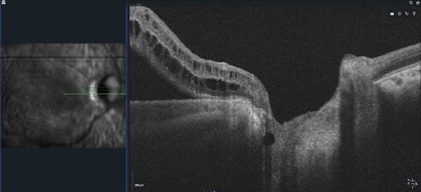 Optic Nerve Pit thumbnail
