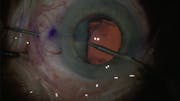 5-0 Prolene Belt-Loop Technique for Scleral Fixation of a Dislocated Intraocular Lens