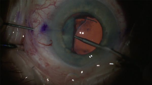 5-0 Prolene Belt-Loop Technique for Scleral Fixation of a Dislocated Intraocular Lens thumbnail