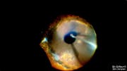 Retinal Detachment with PVR
