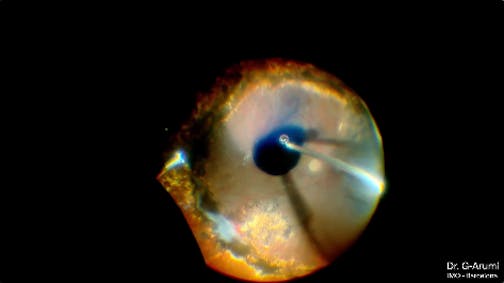 Retinal Detachment with PVR
