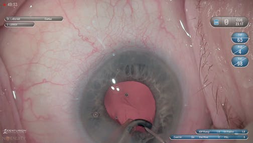 Leveraging Laser Cataract Surgery in Eyes With Small Pupils