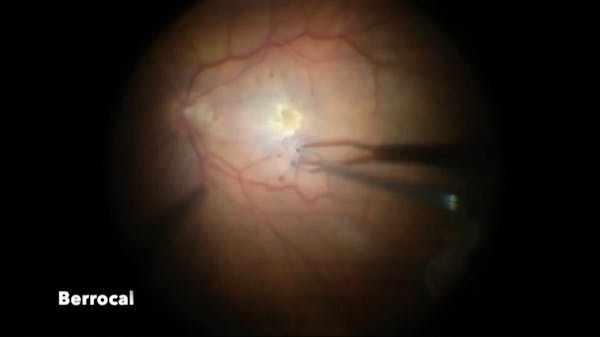 Retinal Detachment and Epiretinal Membrane thumbnail