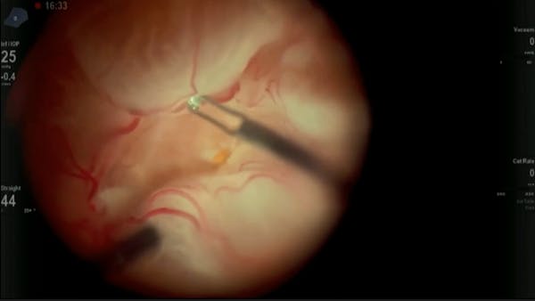 Total Retinal Detachment and PVR thumbnail
