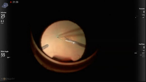 Large Macular Hole thumbnail