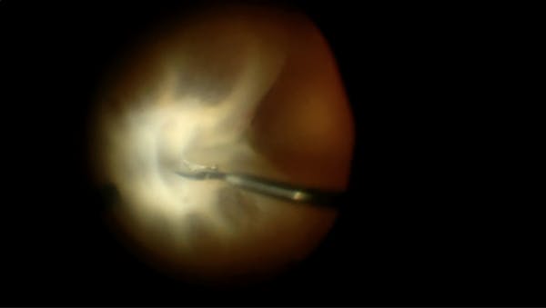 Stage-5 ROP and Tractional Retinal Detachment thumbnail