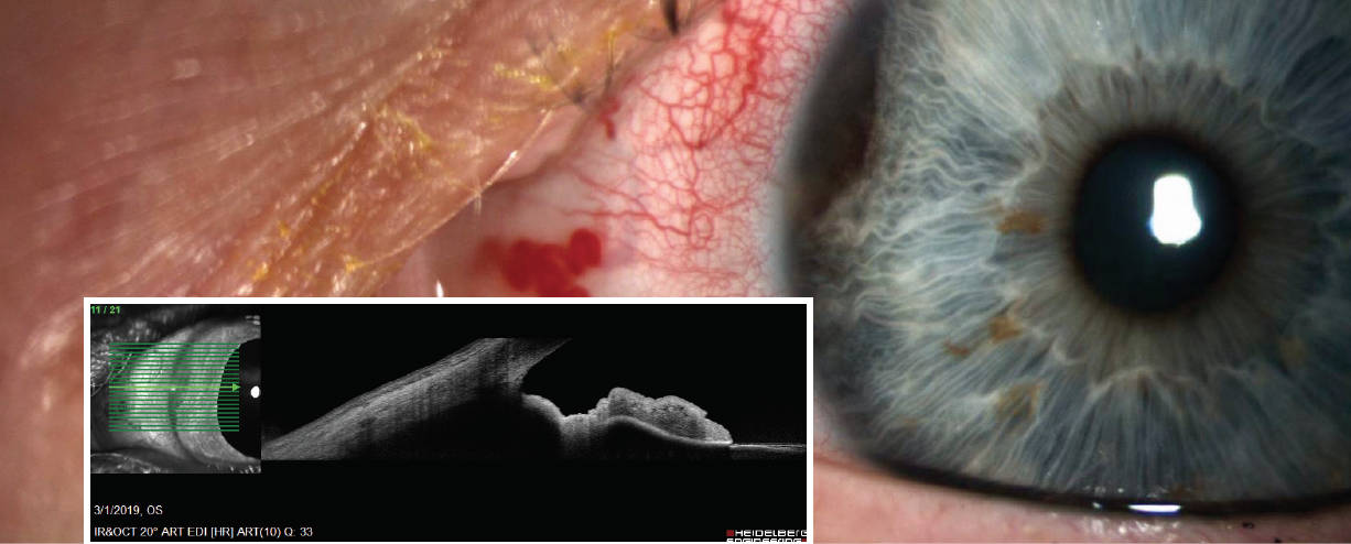 uveal-melanoma-modern-optometry