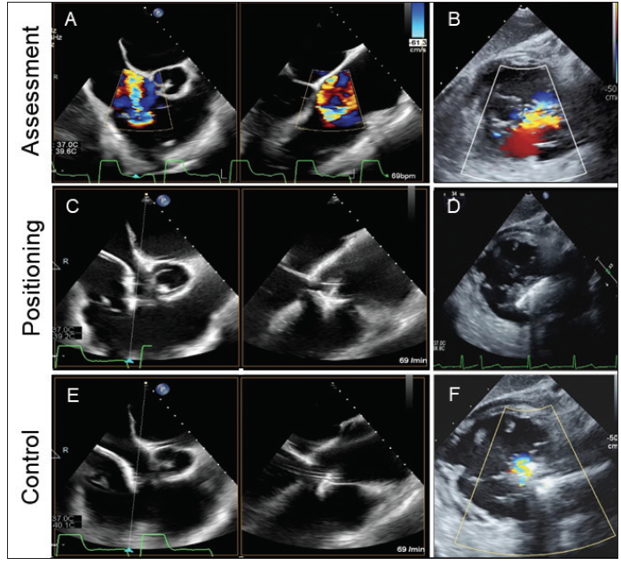 Patient Selection And Periprocedural Imaging For Transcatheter patient-selection-and-periprocedural-imaging-for-transcatheter