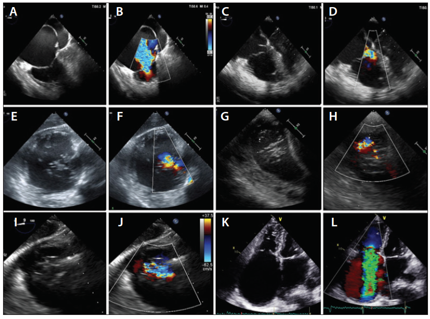 Patient Selection and Periprocedural Imaging for Transcatheter ...