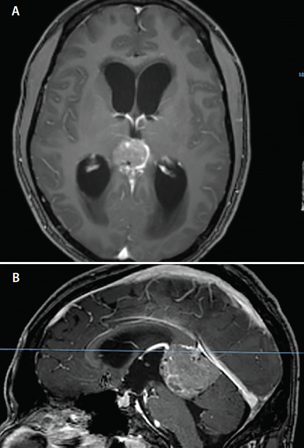 Ventriculostomy and shunts for brain tumours