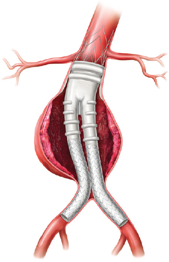 European Innovations - Endovascular Today