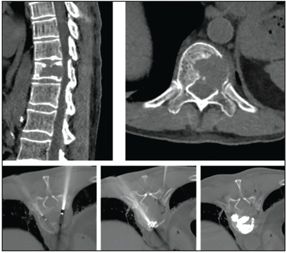 Vertebral Augmentation and Ablation in Cancer Patients With