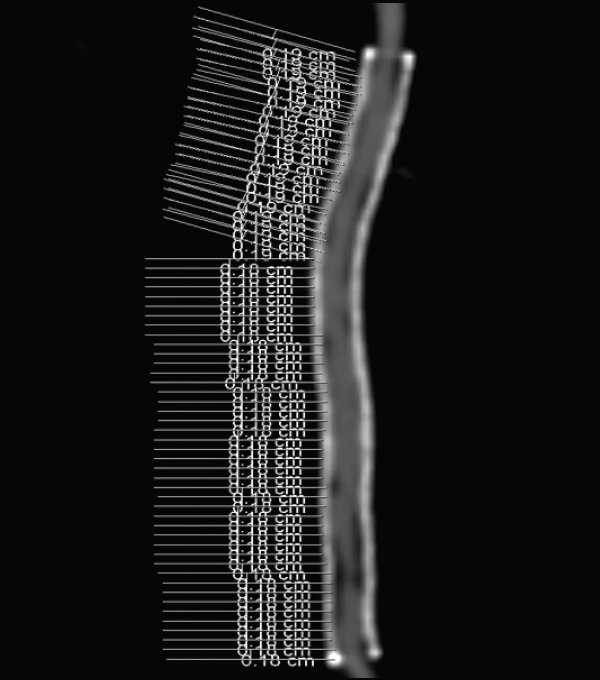Comparison of High Versus Low Chronic Outward Force Nitinol Stents in