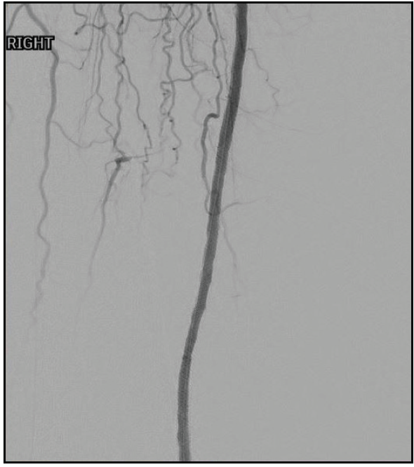 Case Reports: The Auryon Atherectomy System Above And Below The Knee ...